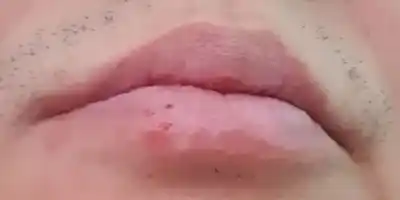 입술포진 원인과 치료제가 없는 이유