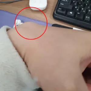 손등에 멍울