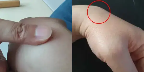 손등에 멍울